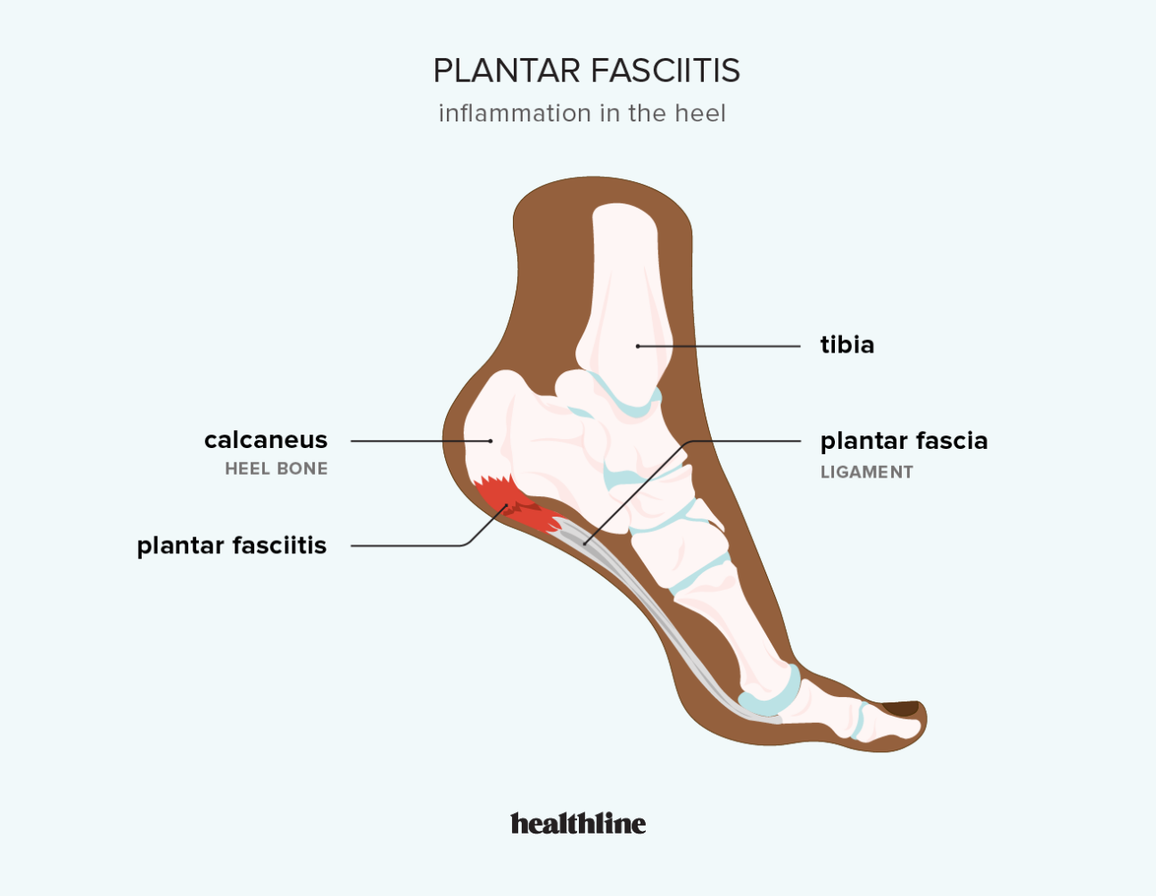 Tendonitis bottom deals of foot