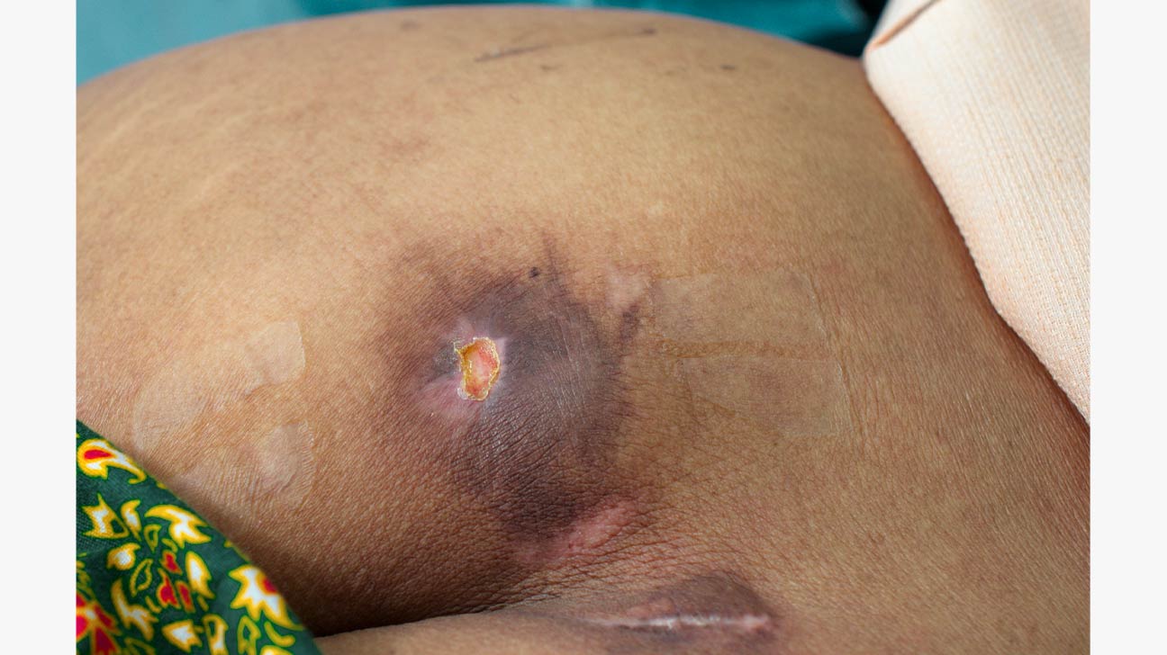 Bedsores (Pressure Ulcers) Condition, Treatments and Pictures for