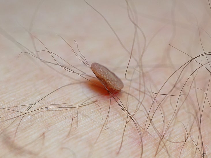 Mole Vs. Skin Tag: Understanding the Difference