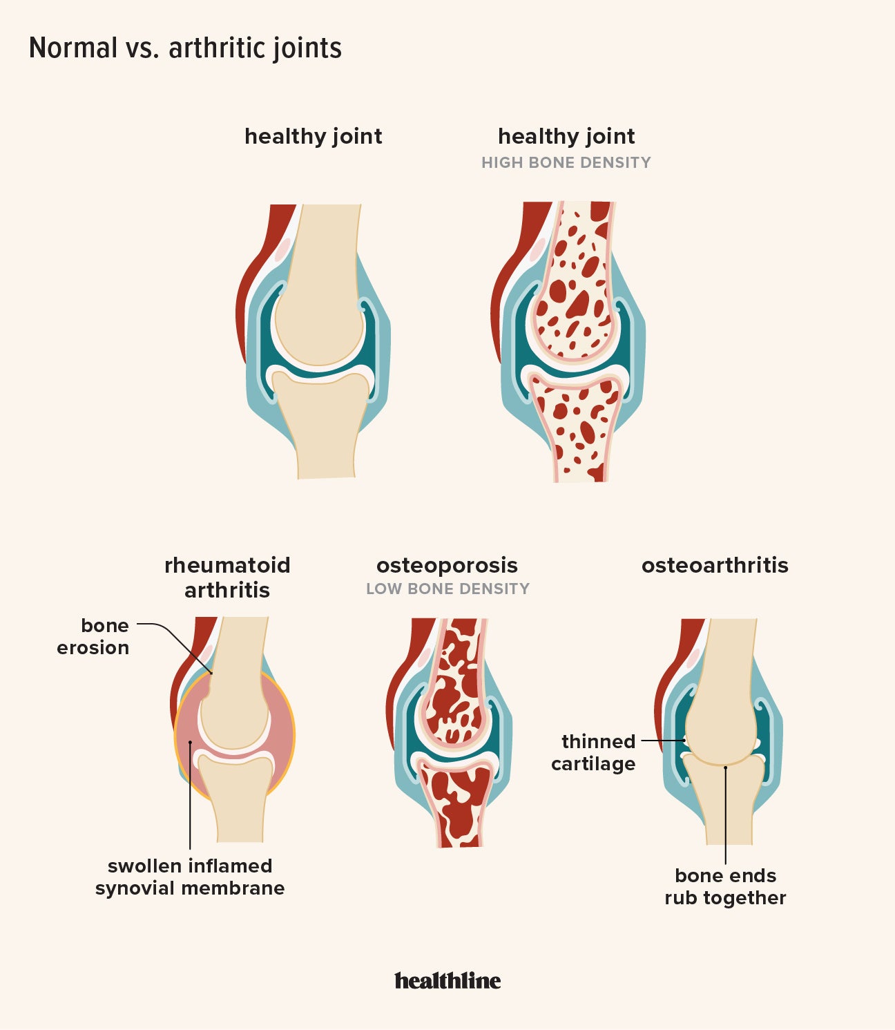 Muscle aches: Causes, home remedies, and prevention