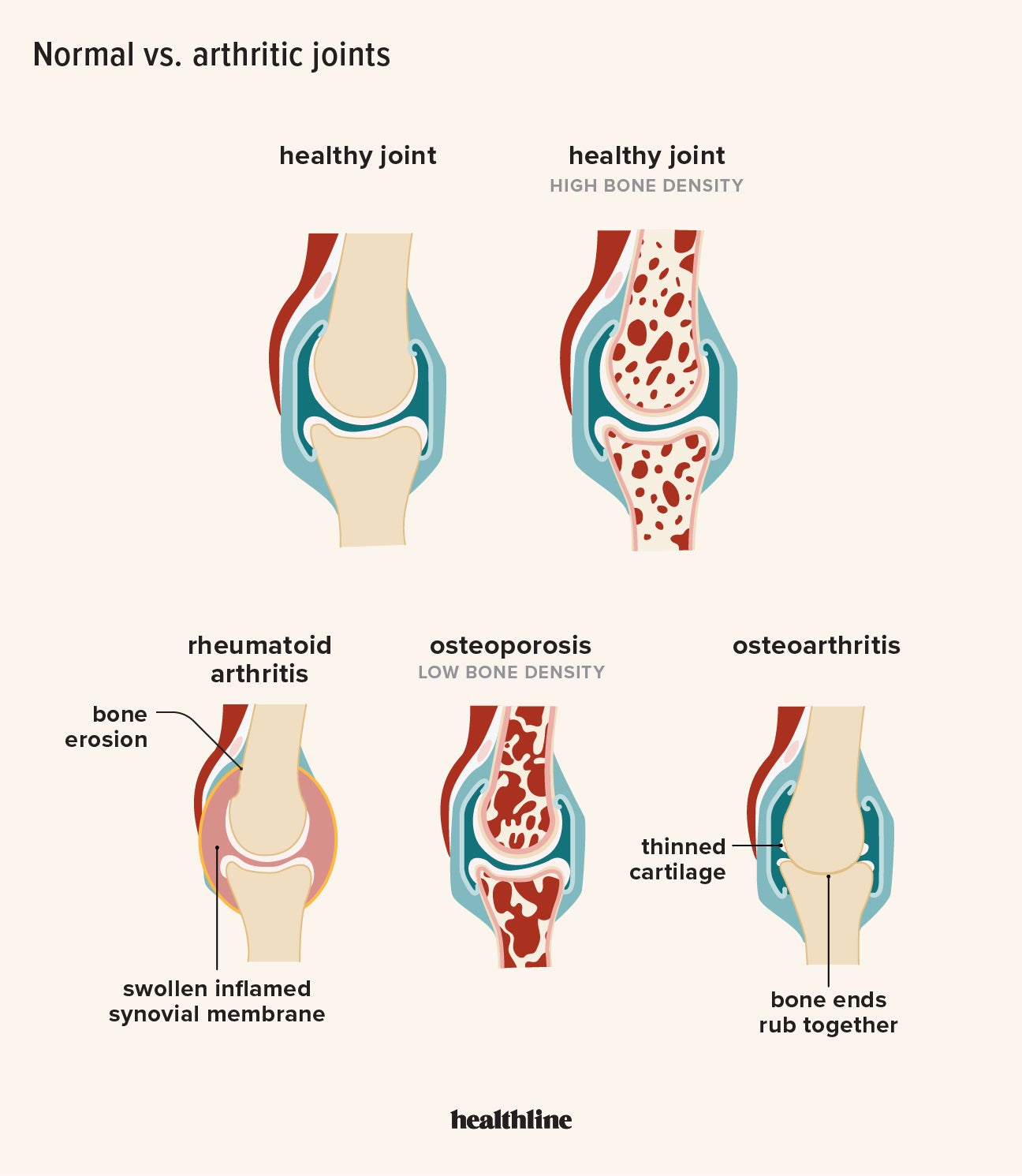 Osteoarthritis Knee Pain Natural Remedies: Soothe & Heal