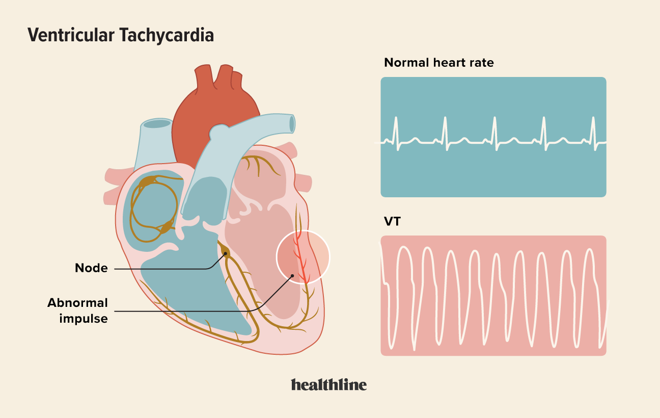 Ventricular Tachycardia Causes Symptoms And Diagnosis