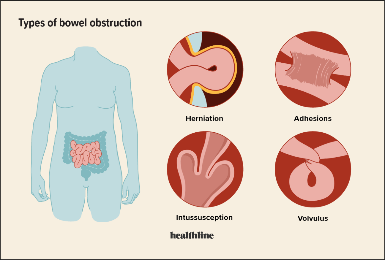 Know What to Do If You Have Bowel Obstruction [Part 1 of 5] 