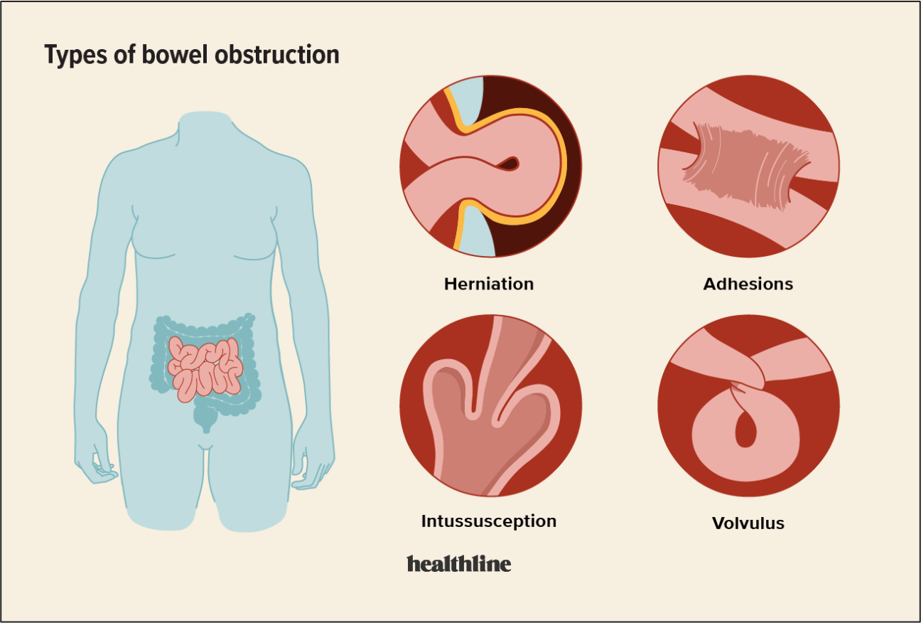 Bowel Obstruction or Intestinal Blockage