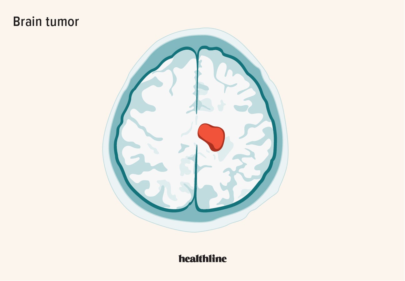 Brain Tumor Causes And Symptoms