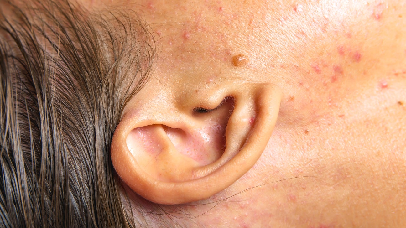 Pimple in ear: causes and how to get rid of them