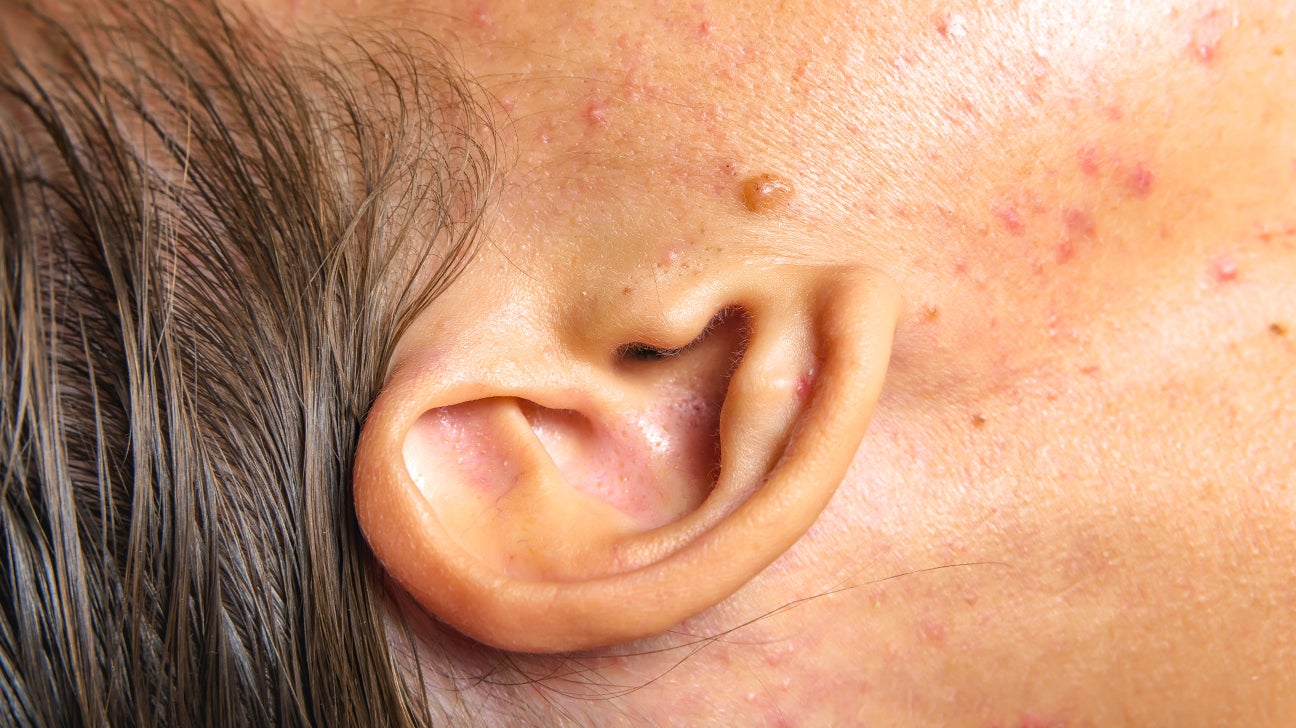 What Causes Lumps Behind The Ears 