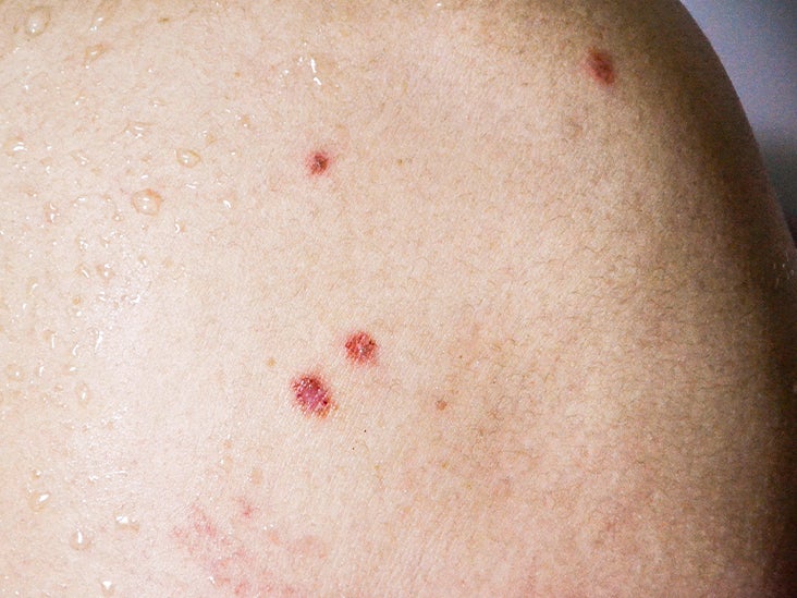 Bowen’s Disease Symptoms, Causes, Diagnosis, and Treatment