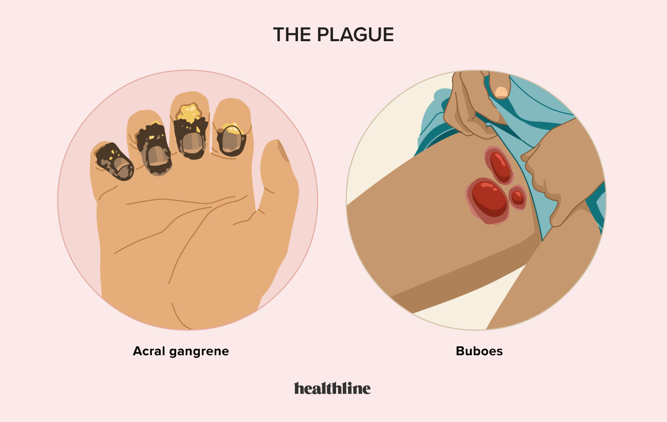 Black Plague Boils The Plague Of Boils SundaySchoolist