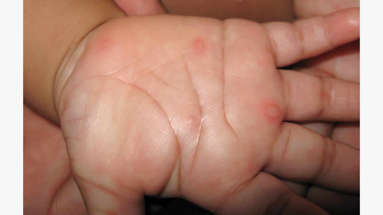 Hand, Foot, and Mouth Disease: Symptoms and Treatment