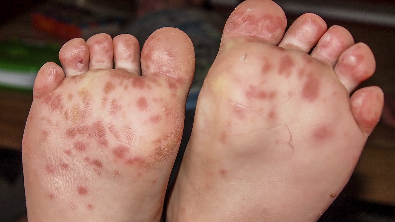 hand foot and mouth disease in mouth