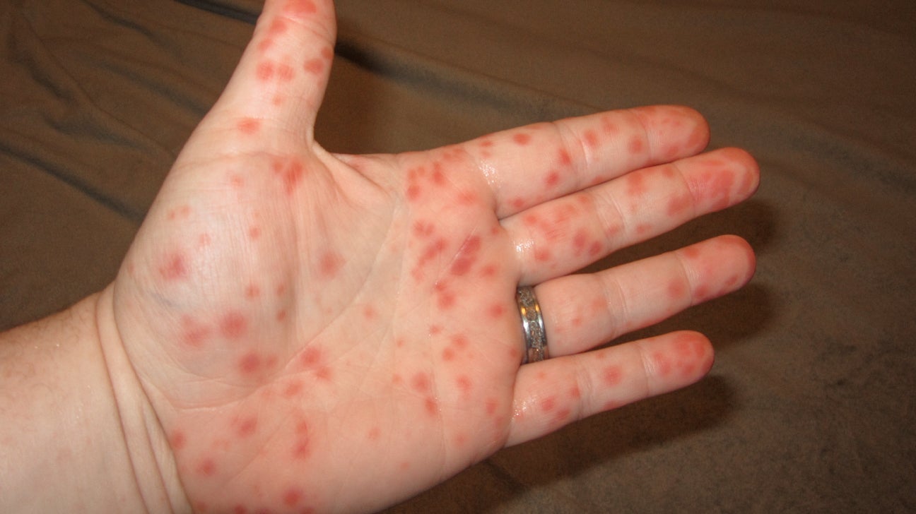 https://post.healthline.com/wp-content/uploads/2022/02/Hand-foot-and-mouth-disease-body5-1.jpg