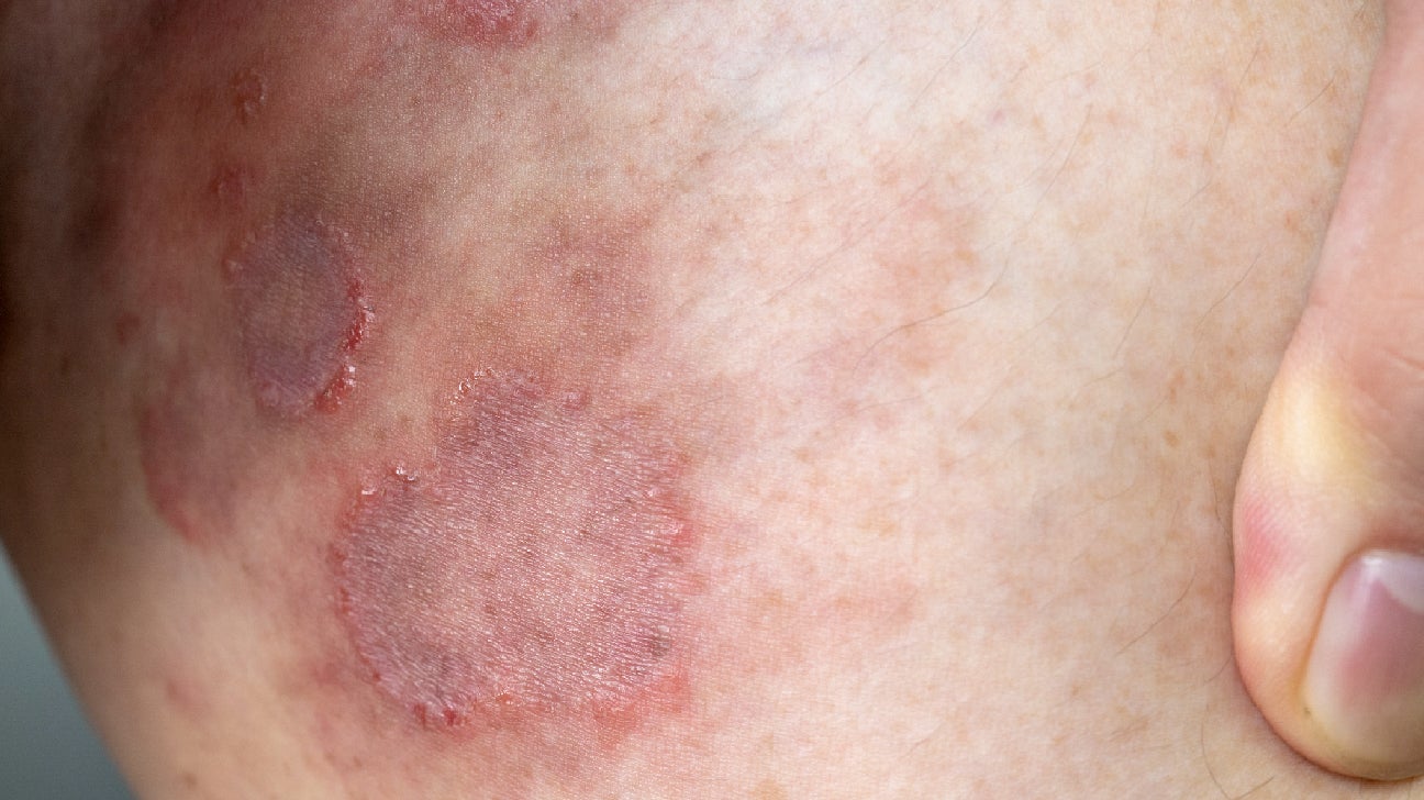 Jock Itch Won t Go Away Ringworm: Symptoms, Pictures, Treatment, Diagnosis, and More