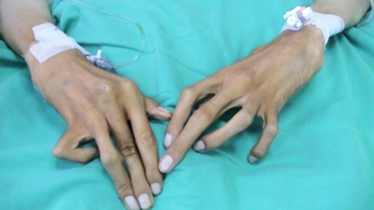 marfan syndrome hands