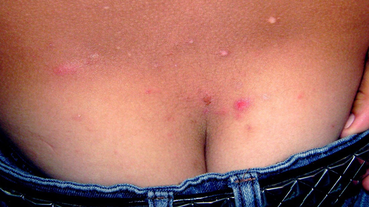 Scabies Symptoms, Pictures, Treatment and More picture