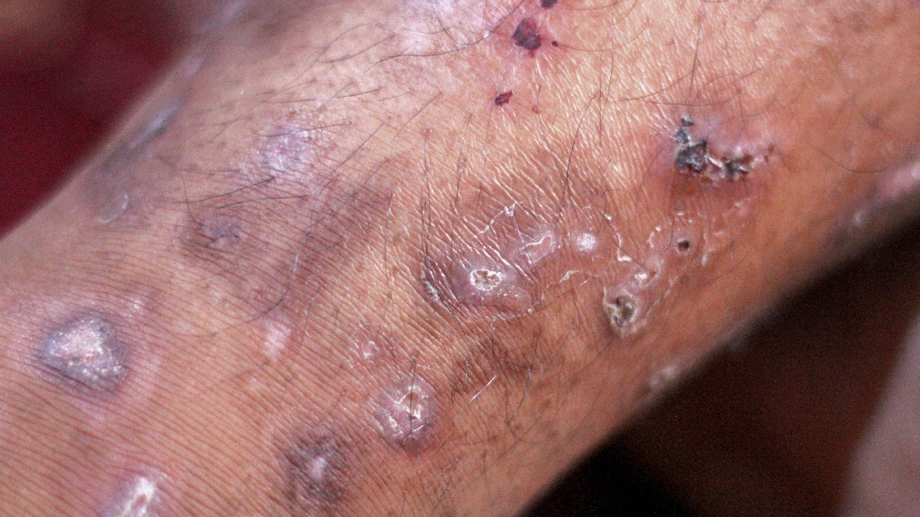 can humans get scabies from dogs