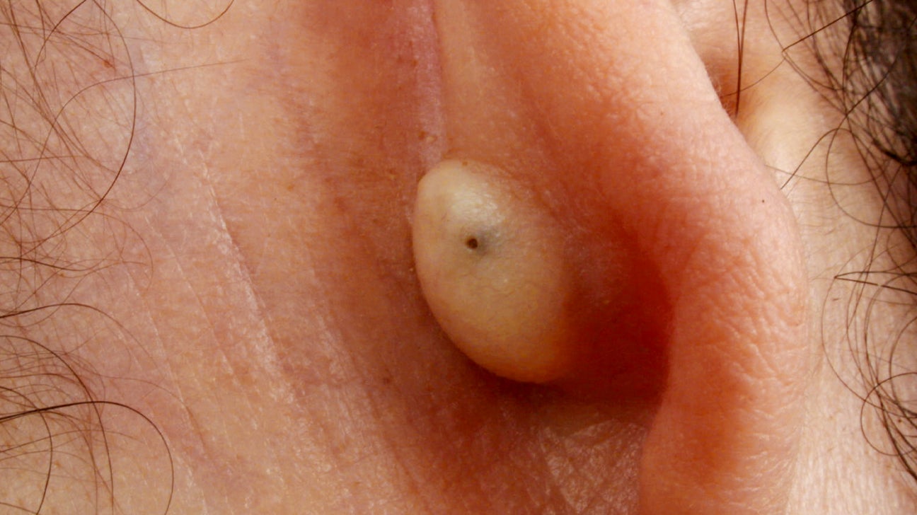cancerous tumor behind ear