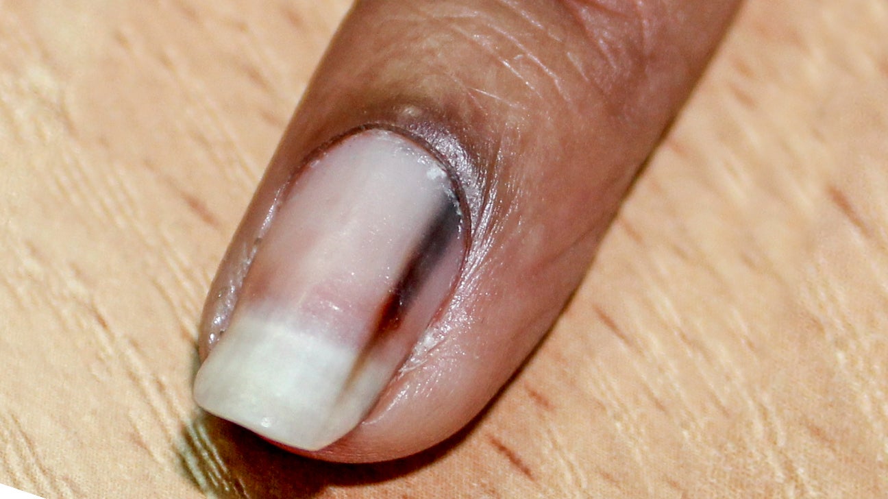 A patient with cancer and nail pigmentation  The BMJ