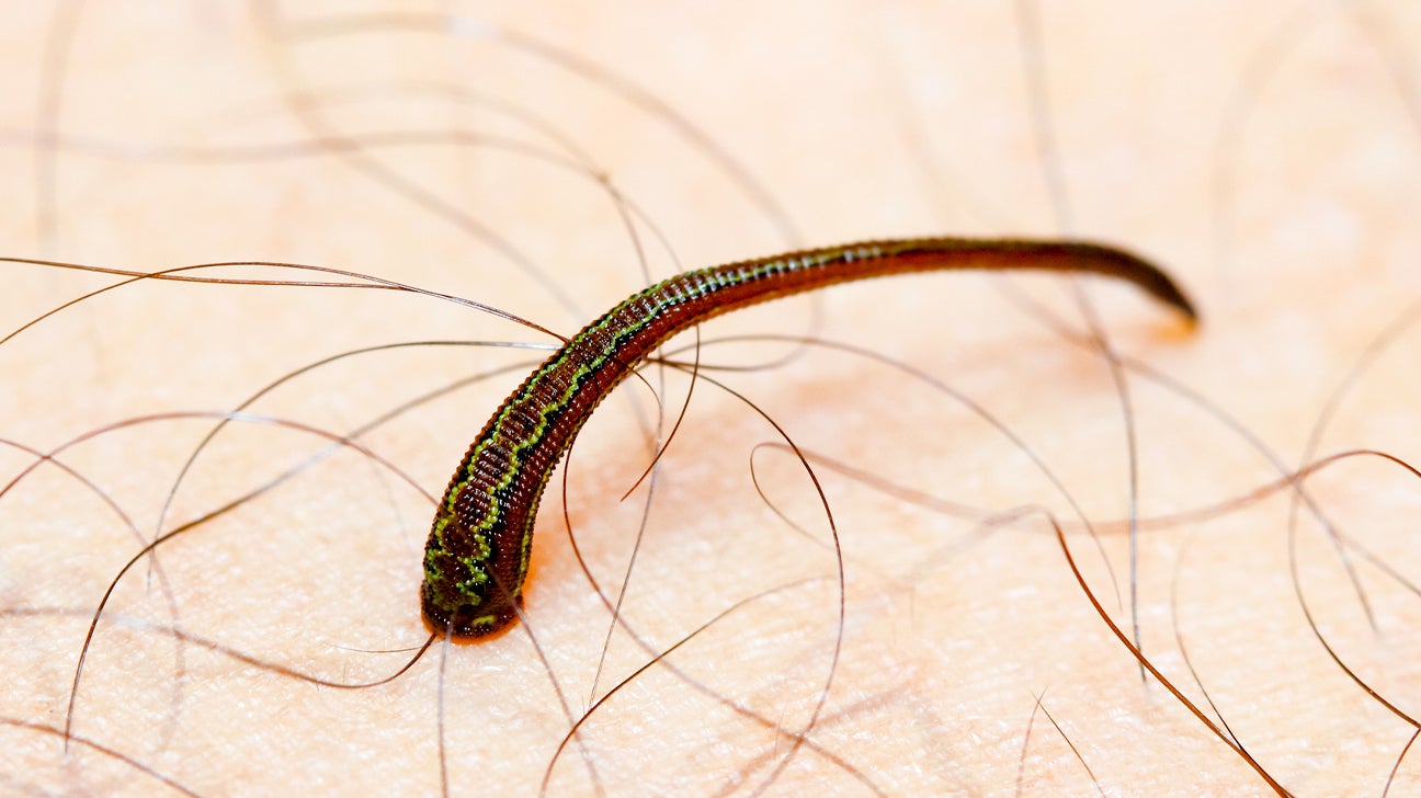 How to Remove a Leech: Steps, Treatment & More