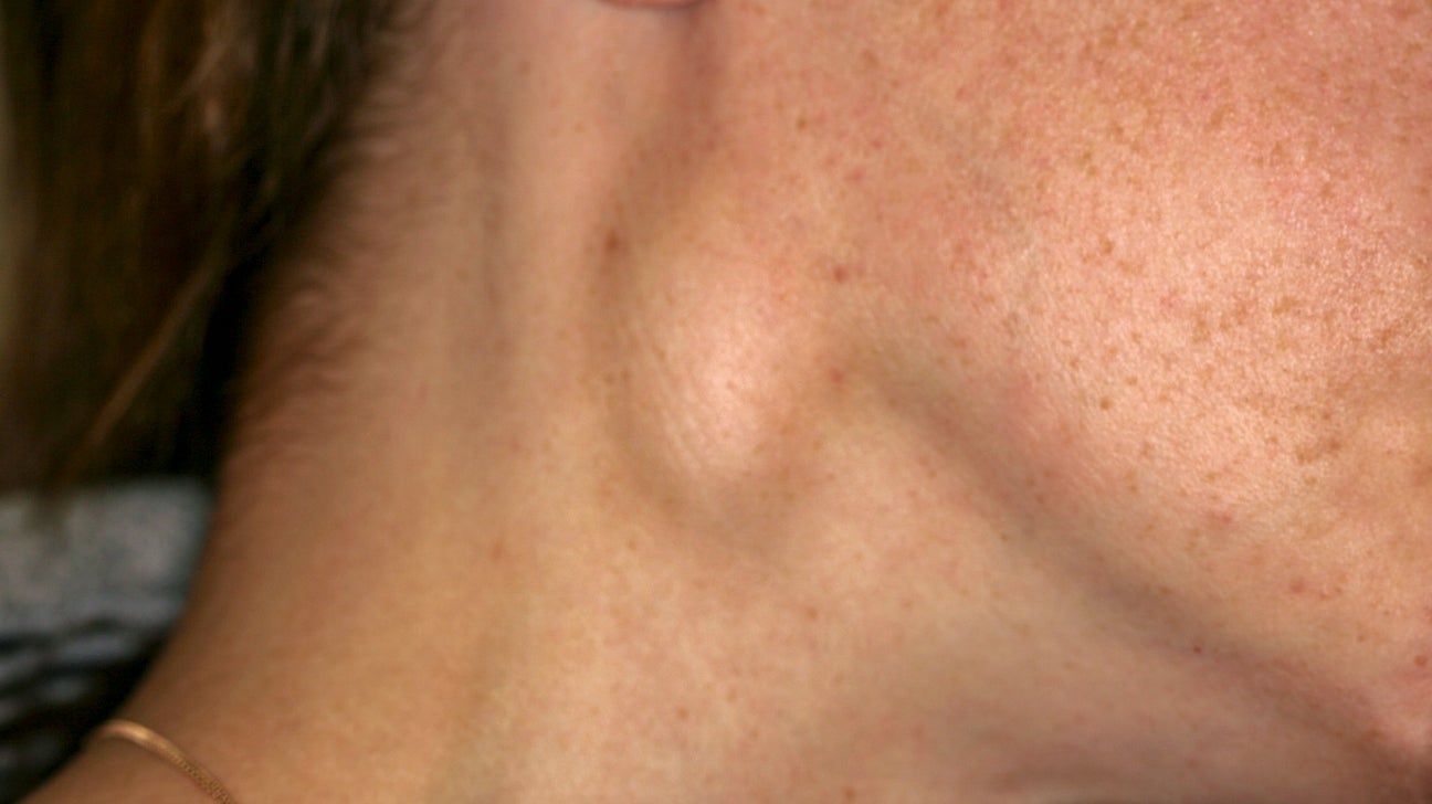 shotty lymph node behind ear