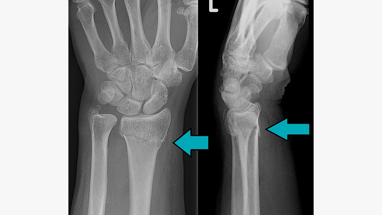 broken hand bones xray