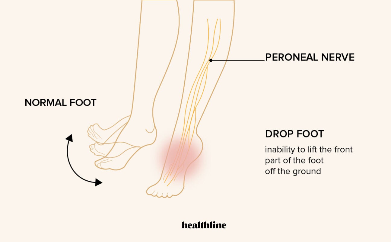 Drop Foot Causes Treatments And More