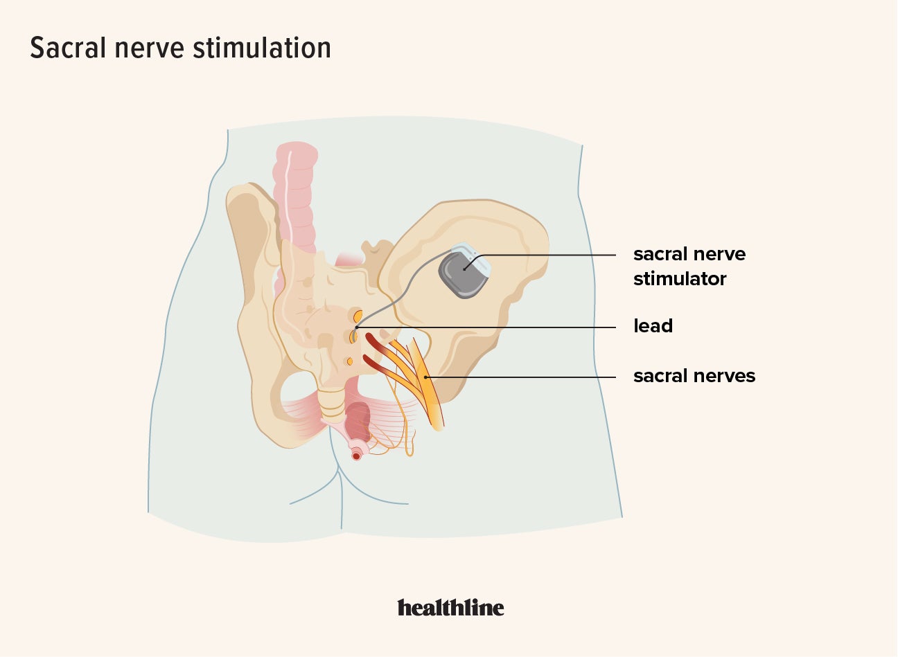 https://post.healthline.com/wp-content/uploads/2022/03/1984068_What-is-Sacral-Nerve-Stimulation-for-an-Overactive-Bladder.jpg