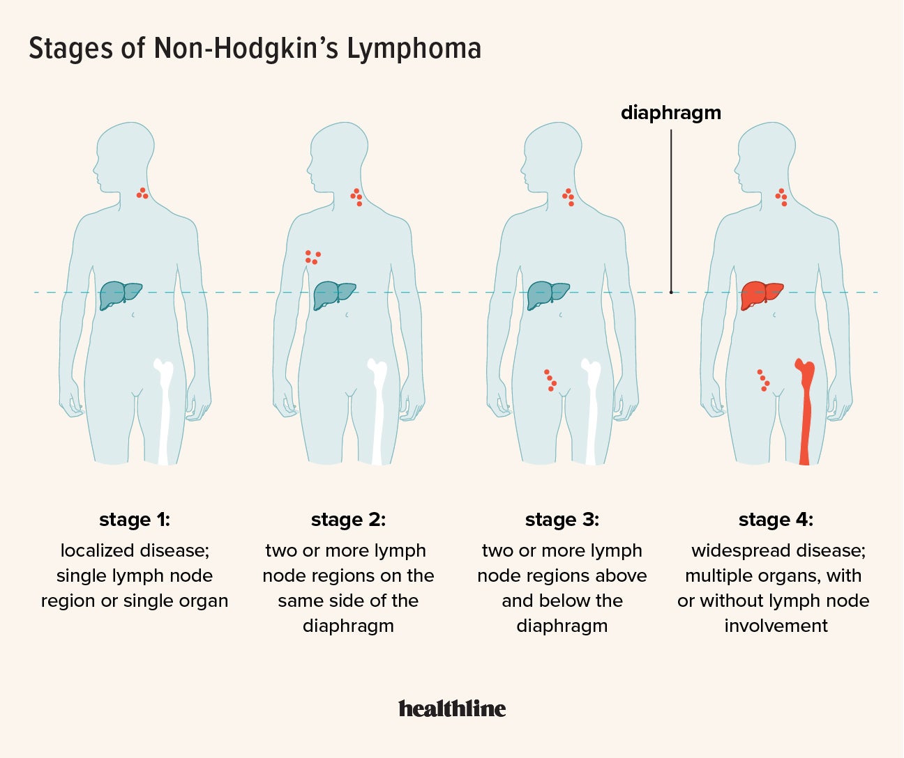 Case Study Non Hodgkin S Lymphoma At Norma Plouffe Blog Case Study Non Hodgkin S Lymphoma At Norma Plouffe Blog