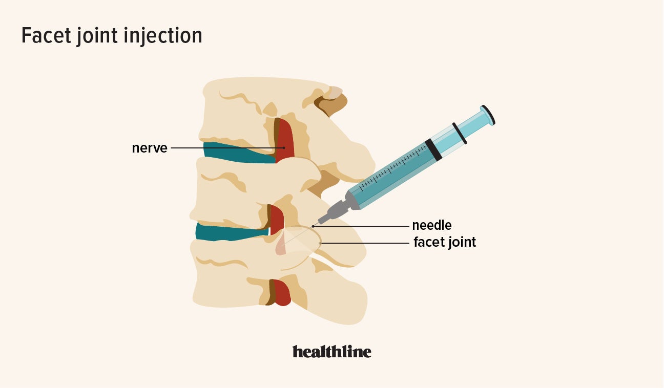 Lumbar Facet Joint Pain - Treatment & Exercises At Home