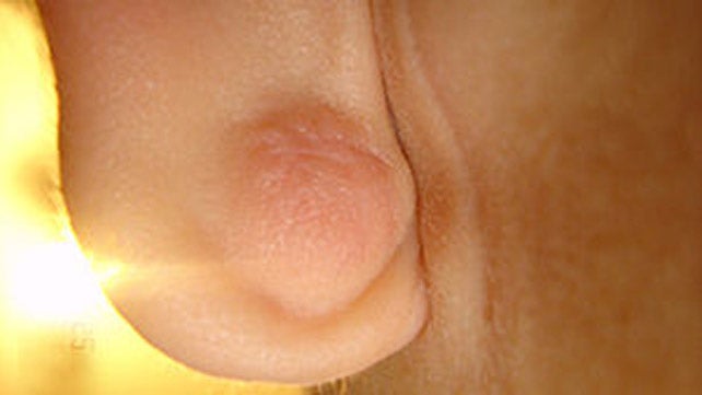 Pimple in Your Ear: Why You Get Acne in Your Ear and How to Treat