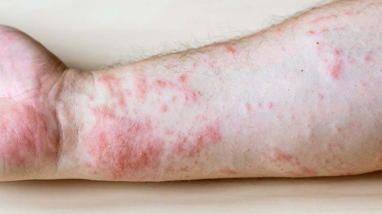 Common Skin Rashes, Pictures, Causes & Treatment