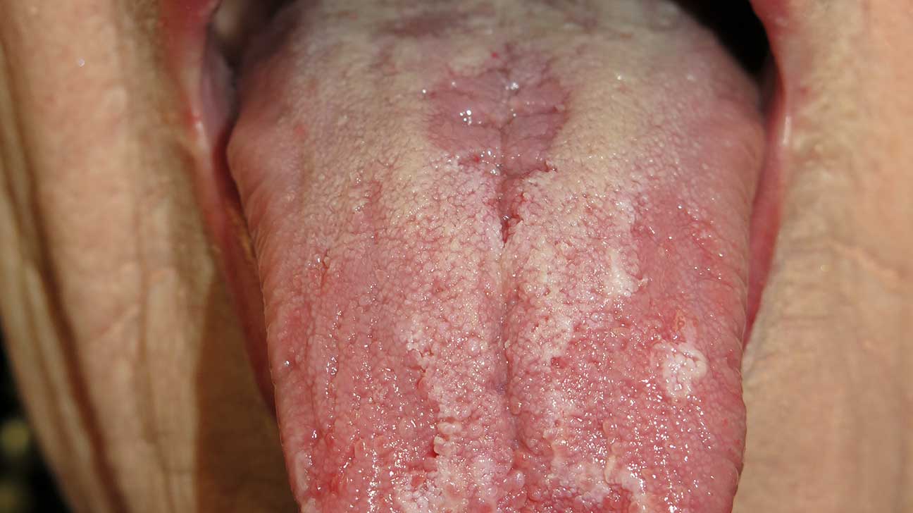 curing acid bumps on tongue