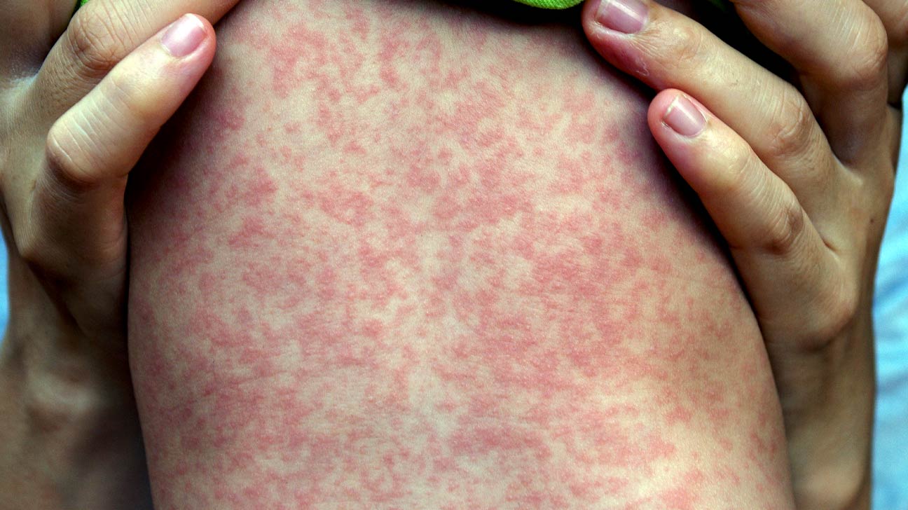 Everything You Need To Know About Rashes EroFound