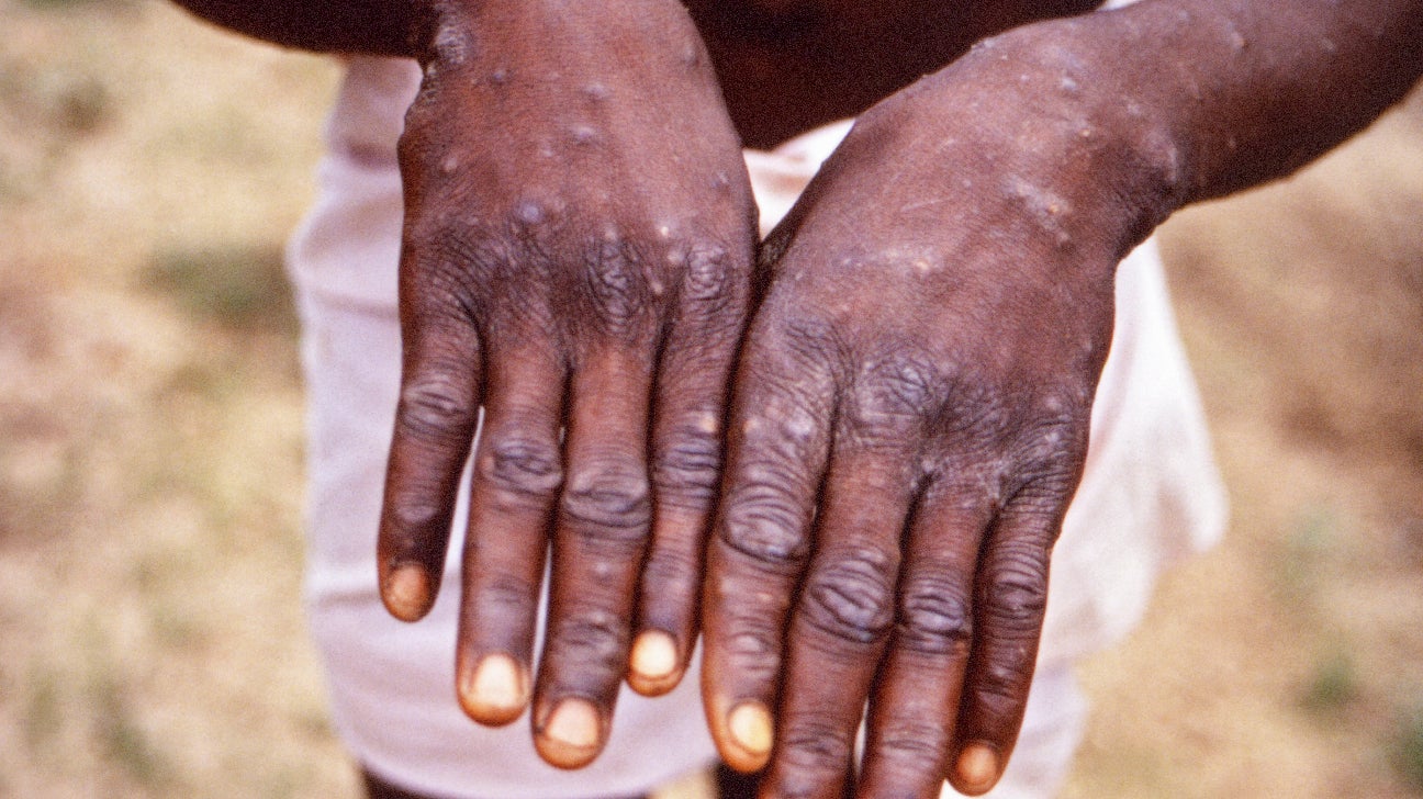 California Man Details Monkeypox Experience