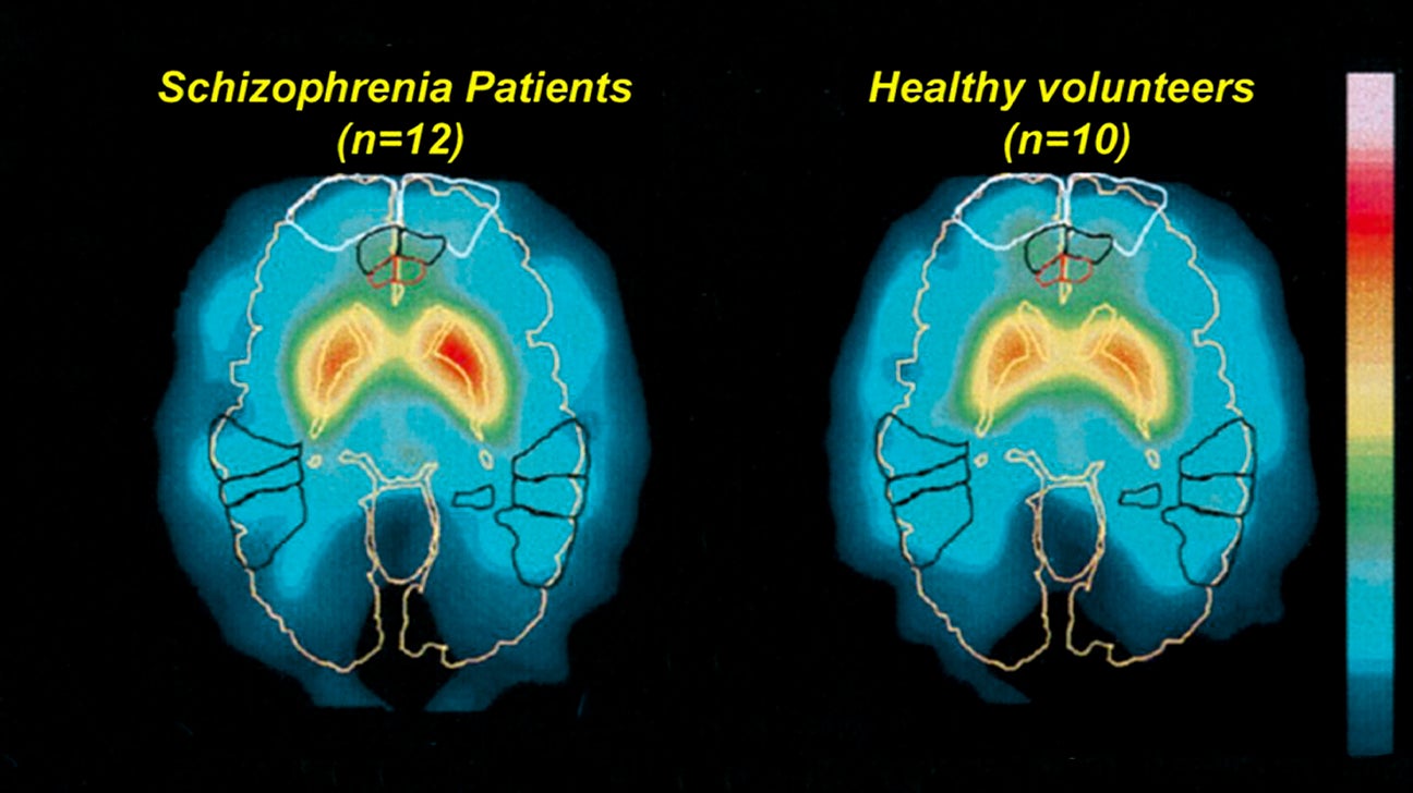 Does Schizophrenia Show On A Brain Scan