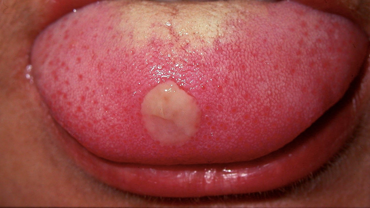 Regeneration Guvernør celle Tongue Bumps: Potential Causes and Treatments