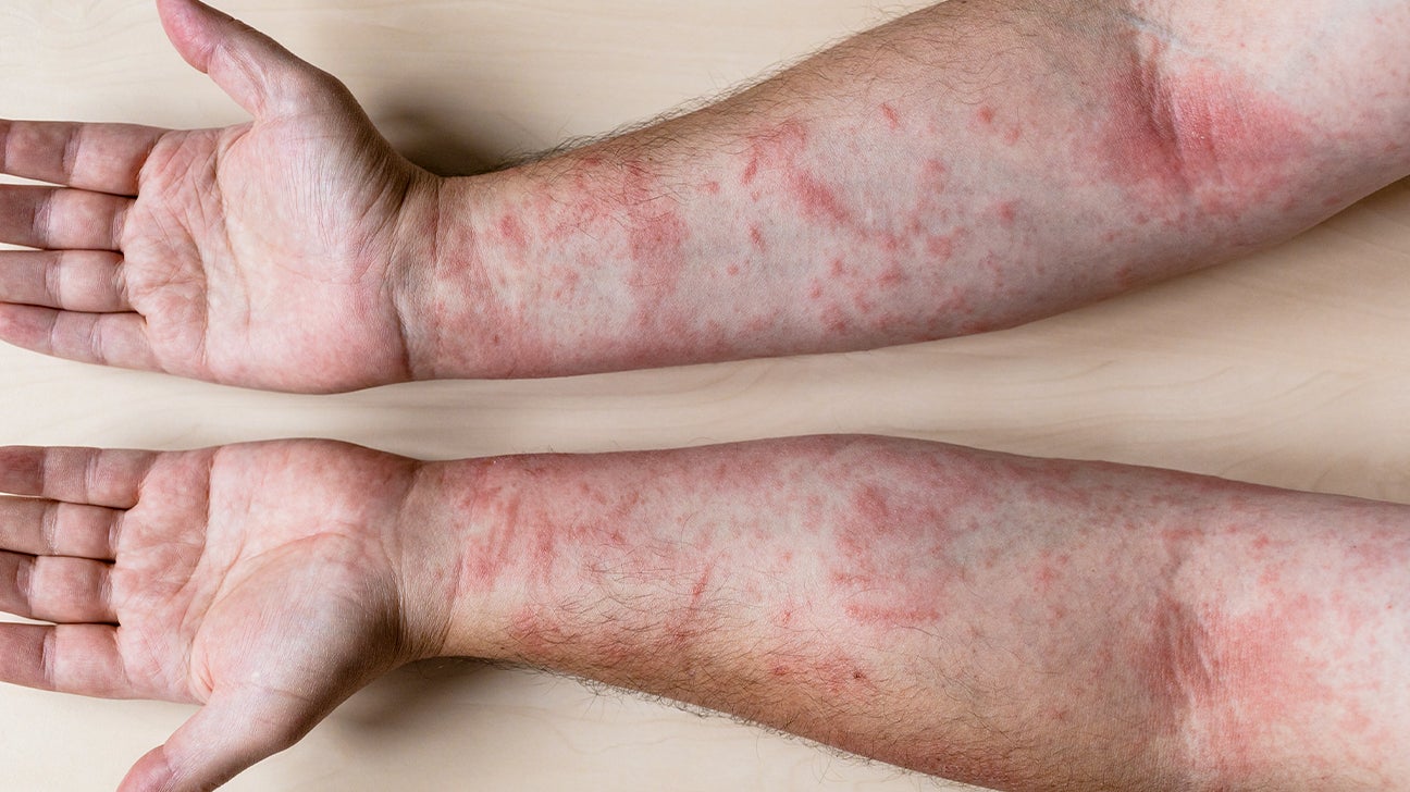 Itchy skin: 14 causes, pictures and treatments