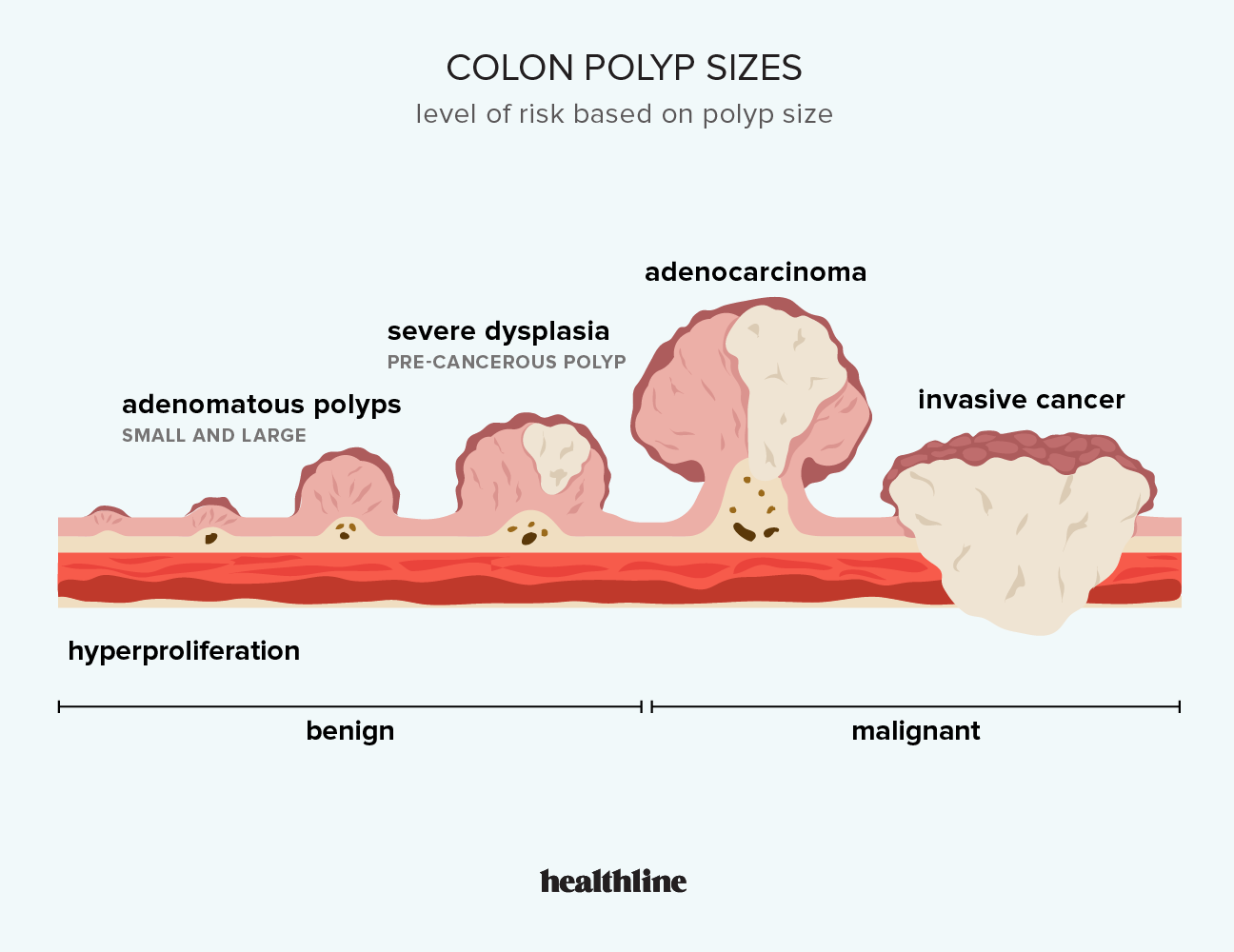 Polyp Size Chart Hot Sex Picture