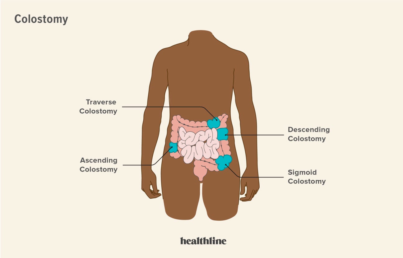 Ostomy Care: Learning Manual Description | PDF | Medical Specialties |  Gastroenterology