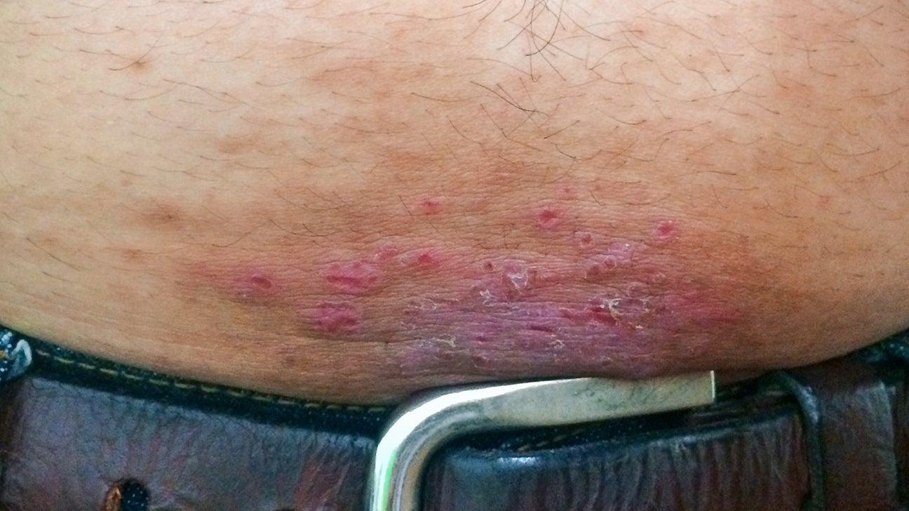 Stomach Rash? You might be allergic to your Belt Buckle. We can help.