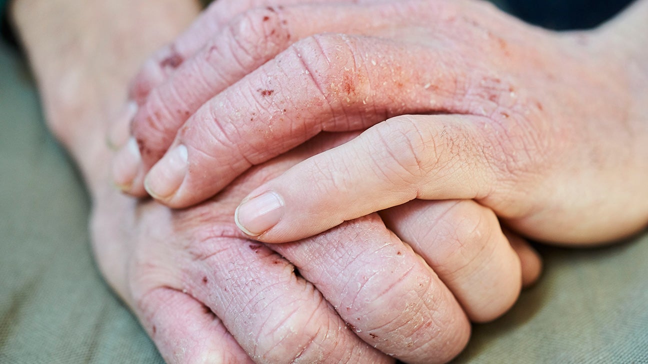 eczema fingertips treatment