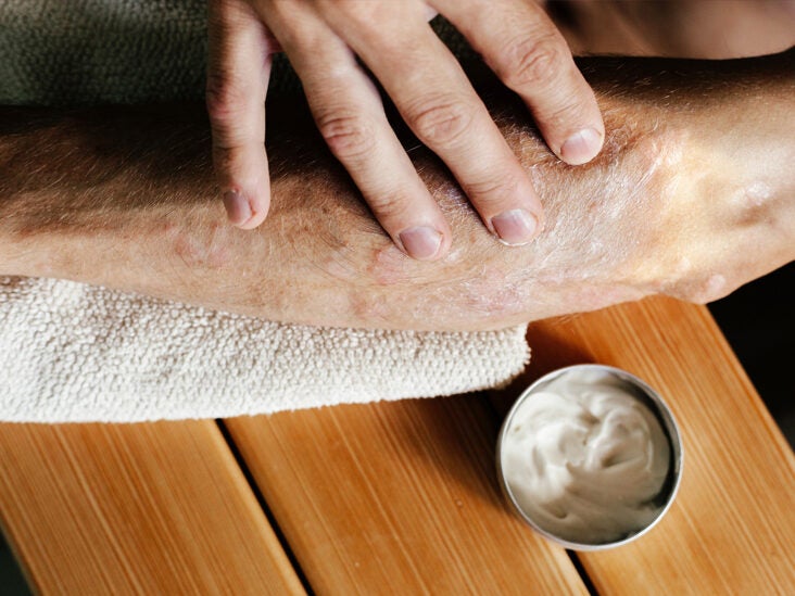 6 Benefits of Trying a New Psoriasis Treatment