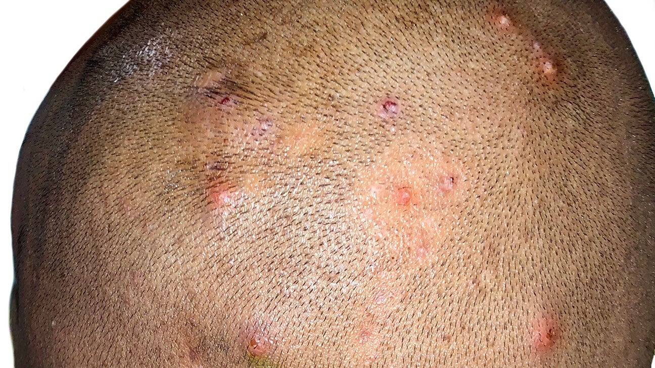 Folliculitis Is Infection And Inflammation Of Hair Follicles Layers Skin  With Pustule That Located Around A Hair Top View Of The Skin With  Inflammation Acne And Rash That Appear As Pimples Royalty