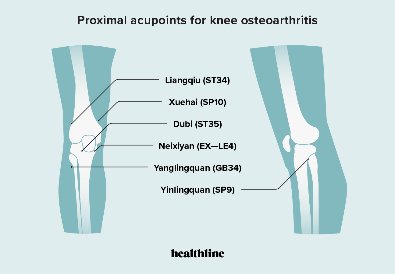 Acupuncture for Knee Osteoarthritis: Procedure and Effectiveness