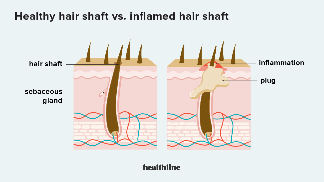 Blocked Hair Follicles Causes Pictures Treatment And Prevention