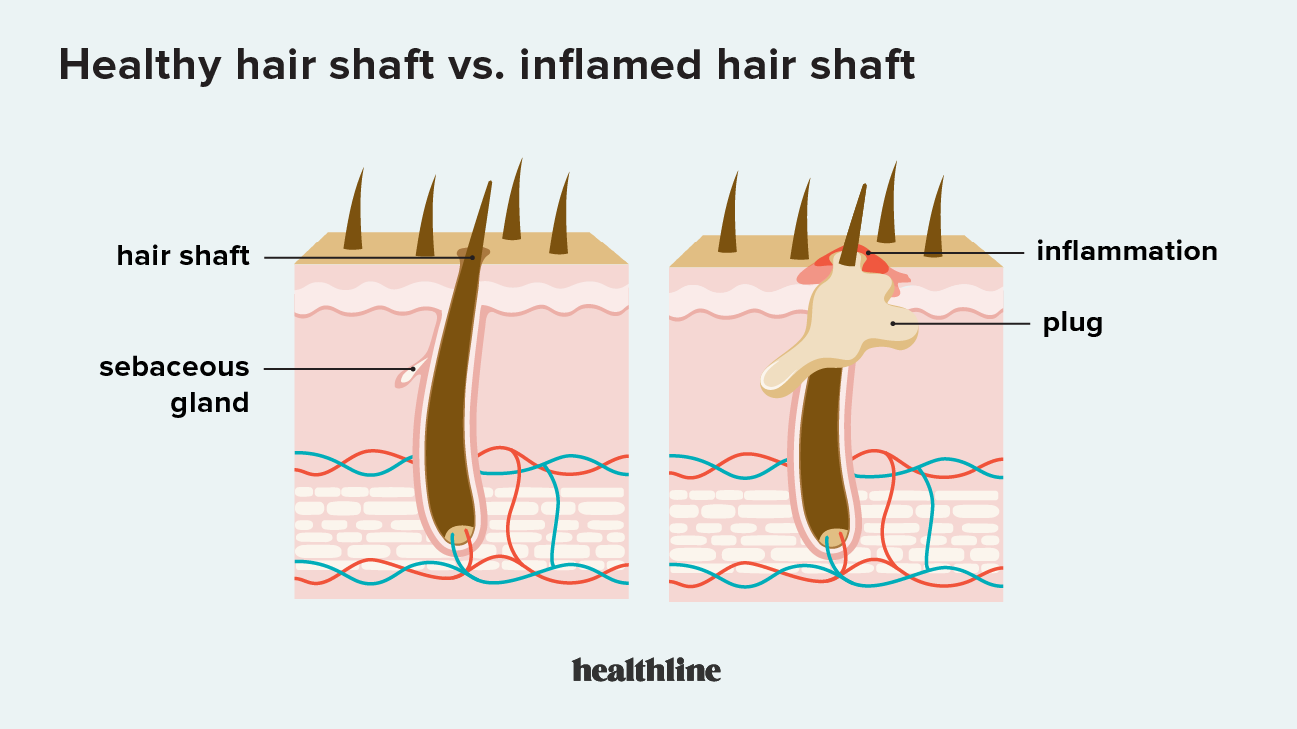 What Do Hair Follicles Look Like