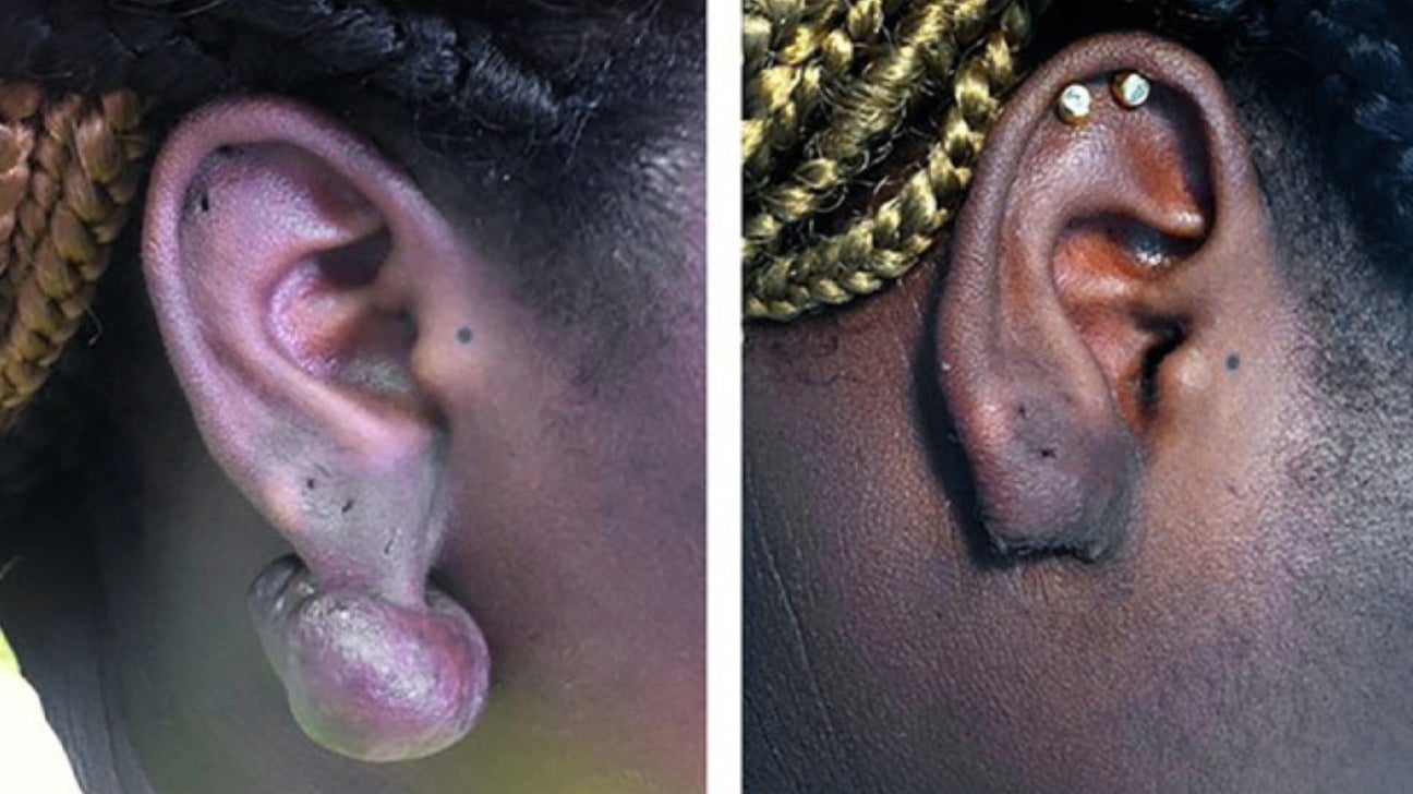 Lift Plastic Surgery - This is a 24-year-old Male patient who got his ears  pierced 1 year ago and since then began developing massive keloids - even  after removing his earrings. The