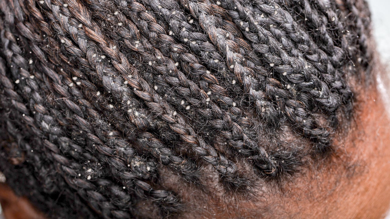 Dandruff Vs Psoriasis How To Tell The Difference