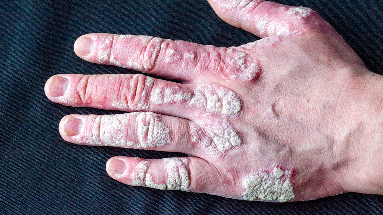 Psoriasis: Causes, Triggers, Treatment, and More