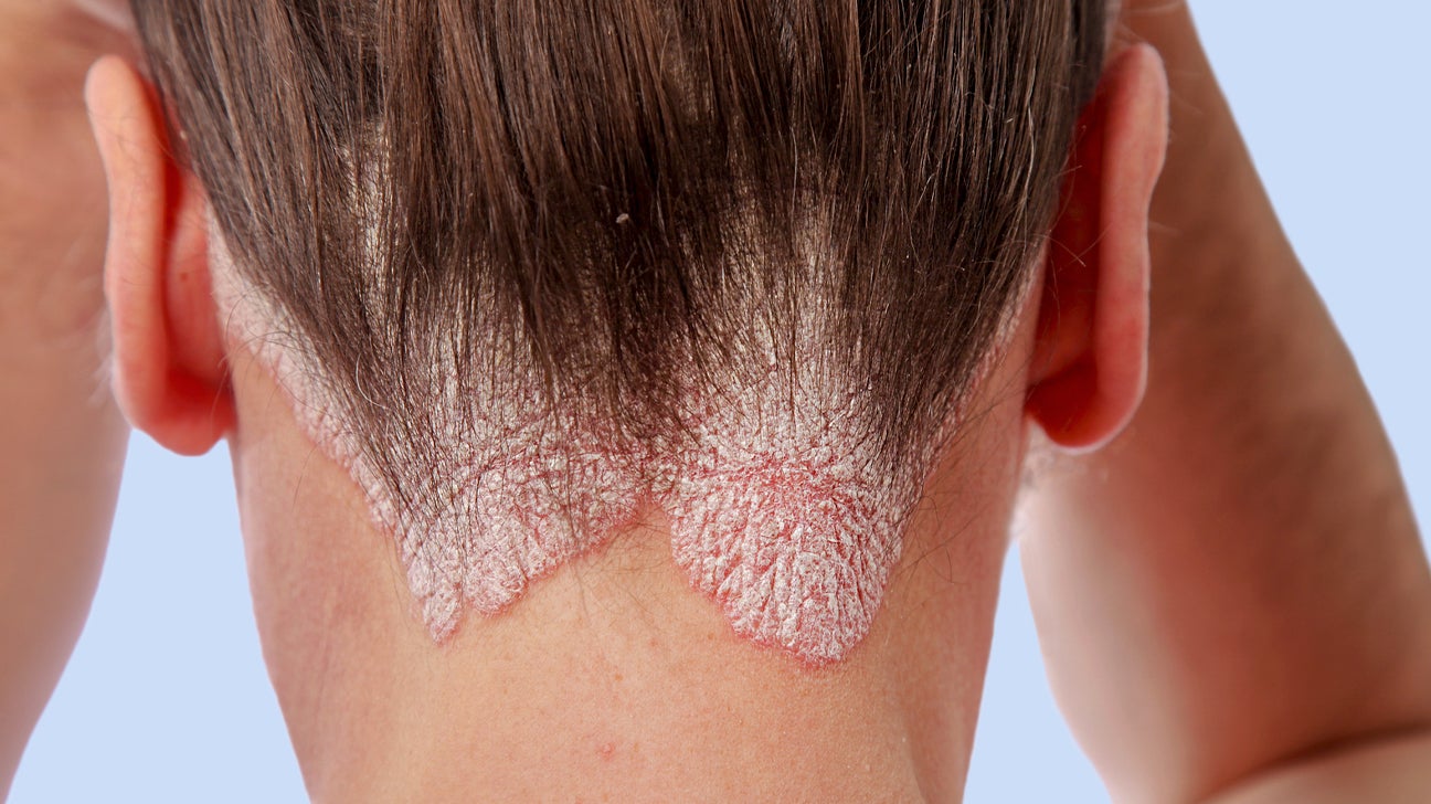 Dandruff vs Psoriasis: How to Tell the Difference